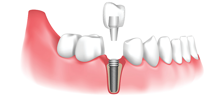 Dental Implants Treatment Dumfries